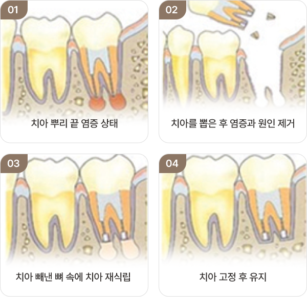 치아 재식술을 표현한 자연치아 보존 치료 이미지